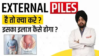 External Piles surgery with laser external hemorrhoid surgery what are external piles how are they d