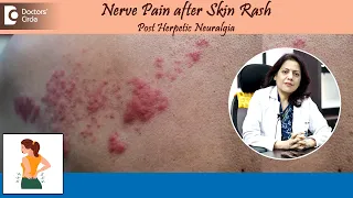NERVE PAIN AFTER SKIN RASH?| Post Herpetic Neuralgia | Herpes Zoster-Dr.Swati Bhat | Doctors' Circle