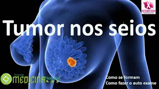 TUMOR DE MAMAS - SAIBA O QUE É - COMO FAZER O AUTO EXAME