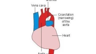 Coarctation of the Aorta