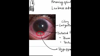 Acute Anterior Uveitis - Case Discussion In A Minute #Shorts