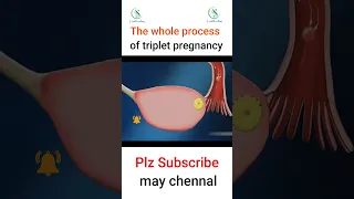 The whole process of triplet pregnancy  #pregnant #triplet #baby #foryou #pregnancy #fypシ #womb