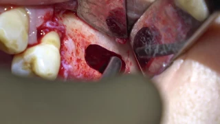 4K - Sinus Augmentation with Xenograft - Lateral Window with Piezoelectric Surgery