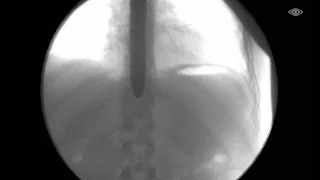 What Happens INSIDE a Sword Swallower: Moving X-ray of Sword Swallower Dan Meyer
