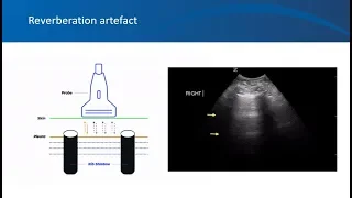 Nephrology ultrasound video 10, University of Florida Nephrology, artefacts, Dr. Koratala (@NephroP)