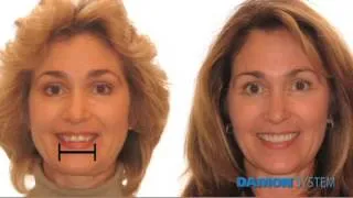 Dr Rebecca Falsafi Orthodontics - Damon System can widen your smile!
