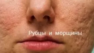 АПТЕЧНОЕ СРЕДСТВО. Чем убрать РУБЦЫ, ШРАМЫ, МОРЩИНЫ, РАСТЯЖКИ.