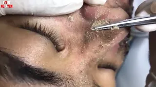 Chemical Peel Result After Treatment Face Peel for Acne