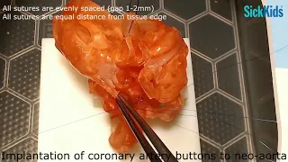 HOST - Arterial Switch Operation (Closed Technique) performed on a 3D heart model - Dr Osami Honjo