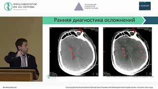 Гибридные хирургич тех-гии в нейроонкологии: перспективы использования плоско КТ с контрастированием