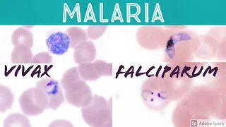 Malaria blood smear: Plasmodium falciparum vs vivax (headphone ring trophozoite banana gametocyte)