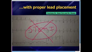 Amal Mattu's ECG Case of the Week_ Oct 21, 2013