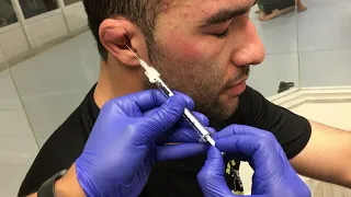 Treating Cauliflower Ear, J2L/ATOS Long Beach