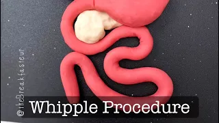 Playdough Surgery 🔪🍐 - Pylorus-Preserving Pancreaticoduodenectomy AKA Whipple Procedure - Part I