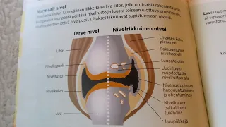 Остеоартрит, Лечение, Финляндия, Лайфхаки