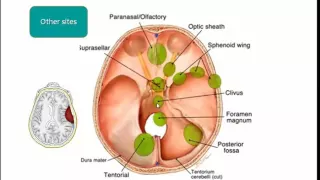 Imaging of Brain tumors   DRE 3   Dr Mamdouh Mahfouz