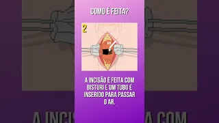 O QUE É TRAQUEOSTOMIA #shorts