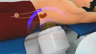Kidney Stones: Actual ESWL procedure