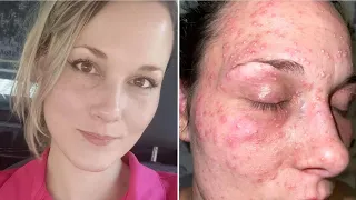 Police News - Texas Mom Claims Police Cuffed Her On Pile Of Fire Ants As They Bit Her On Her Face