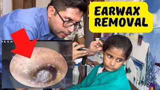 Earwax Removal from young Girl | How to remove hard wax  | Video otoscaopy | Earwax