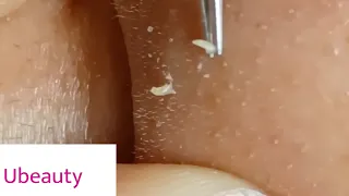 No squeezing whiteheads removal (Facial 33 tip of the nose)