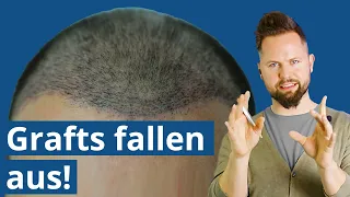 Können Grafts wirklich wieder ausfallen? Haartransplantation Türkei