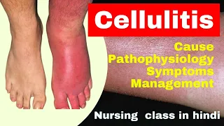 cellulitis nursing lecture in hindi | cause, symptoms, treatment | skin disease | msn