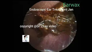 "SATISFYING SKIN BLOCKAGE & IMPACTED EAR WAX REMOVAL - Ep 6"