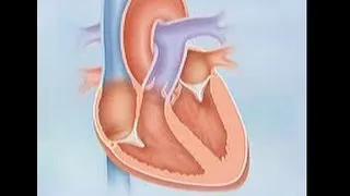 Systolic Heart Failure