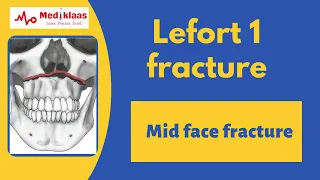 Le Fort I Fracture l Mid face fracture l Oral surgery l Mediklaas