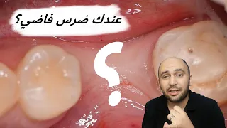 ليه لازم تعمل زراعة أسنان أو تركيبات الاسنان  بعد خلع ضرسك؟