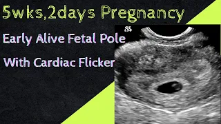 Early Pregnancy 5 weeks , 2 days - with Alive Fetal Pole Showing Cardiac Flicker