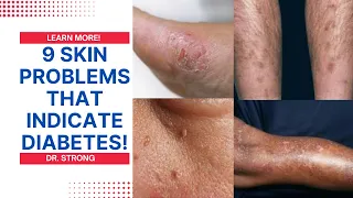 "9 Diabetic Skin Problems You Shouldn't Ignore: Signs of Diabetes You Need to Know"