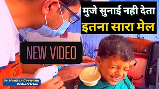 इतना सारा कान का मेल | बिना दर्द के केसे निकला इतना सारा मेल | How to Remove Large Stone like earwax