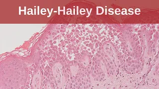 Hailey-Hailey Disease - Pathology mini tutorial