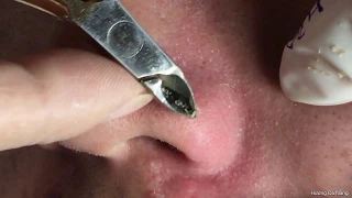 #001 Awesome blackheads removal on nose | Mụn đầu đen trên mũi | akne Behandlung, trattamento acne