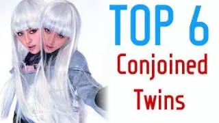 Top Six Conjoined Twin Pairs in History