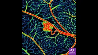 Retinal Hemangioblastomas associated with VHL Syndrome. Before and instantly after treatment.