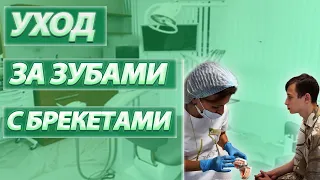 Как чистить зубы во время лечения на брекет системе? Брекеты. Ортодонтия и ортодонт в СОЧИ