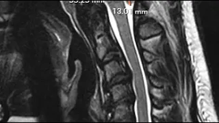 Chiari 1 Malformation - Brain MRI scan | First Look MRI