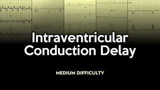 Intraventricular Conduction Delay ECG Quiz: Medium Difficulty