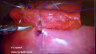 LAEBOT3D2D: Pancreaticojejunostomy - Robotic Surgery Suturing