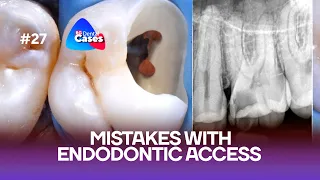 Mistakes with endodontic access. Step by step | BG Dental Cases #27