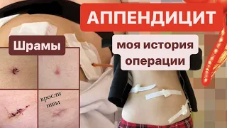 АППЕНДИЦИТ - мой главный страх | вросли швы, моя история