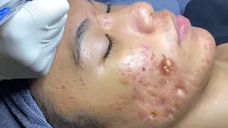 Make your Acne Treatment Huong Da Nang​ | acne 2022 Part15