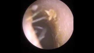 807 - Itchy Ear Wax Removal & Dead Skin Peel