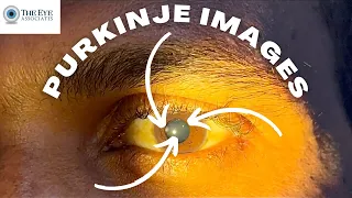 Purkinje Images