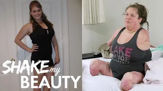 I Lost All My Limbs At 18 | SHAKE MY BEAUTY