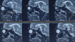 Anterior Communicating Artery Giant Aneurysm with Vision Loss