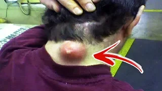 Top 10 Satisfying Pimple Popping Videos